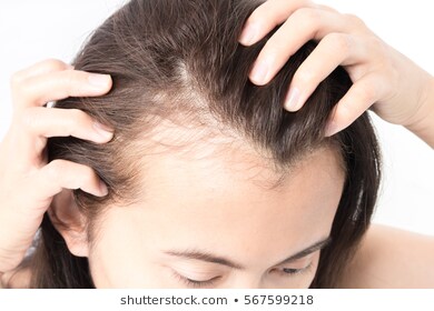 5 triggers of thinning and hair loss in women