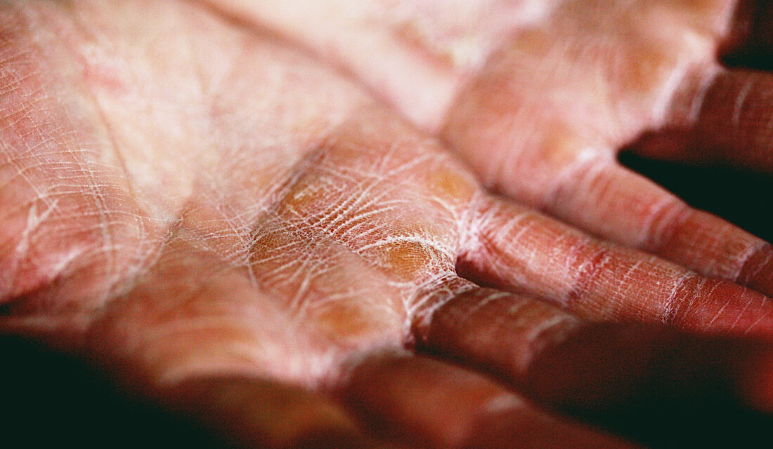 This week is National Eczema Week, Are you getting involved?