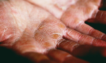 This week is National Eczema Week, Are you getting involved?