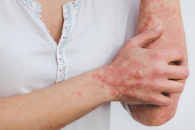 Psoriasis Awareness Month 2025: Raising Action and Understanding for Better Lives
