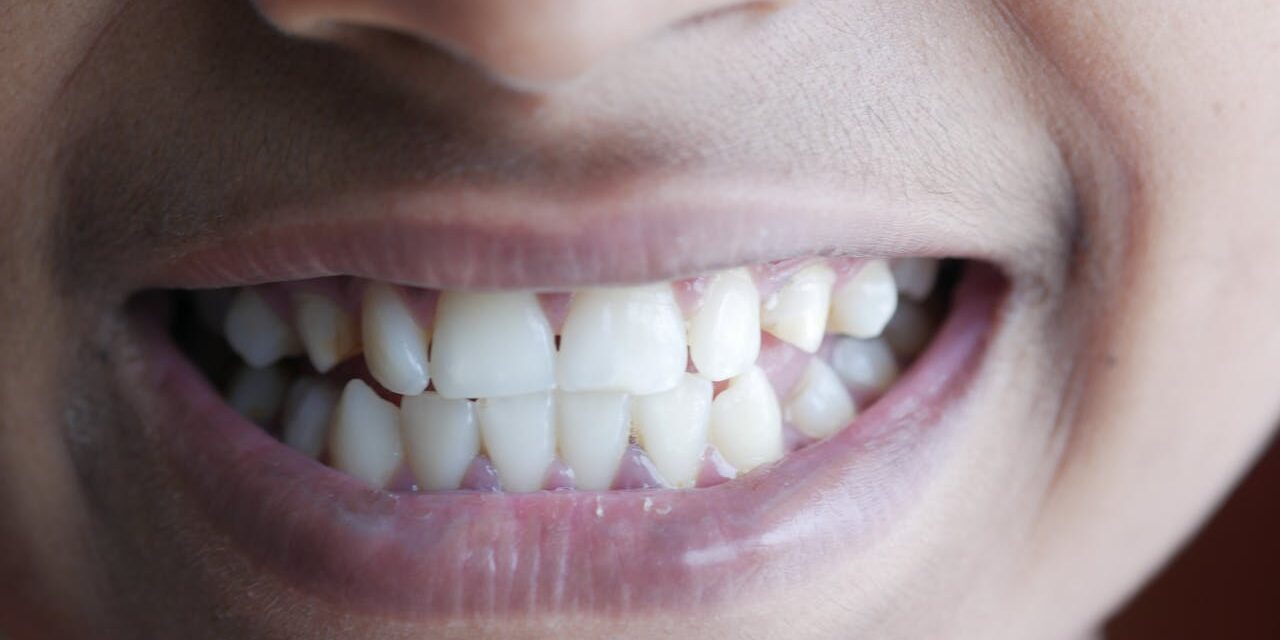 Why Your Teeth Don’t Feel as Clean as You Think